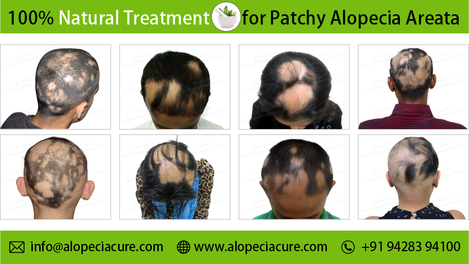 alopecia areata